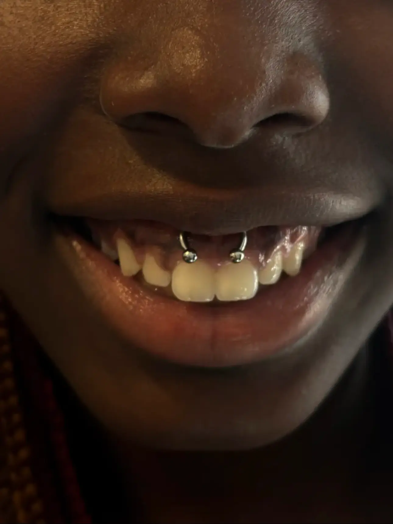 Smiley piercing with a beaded ring
